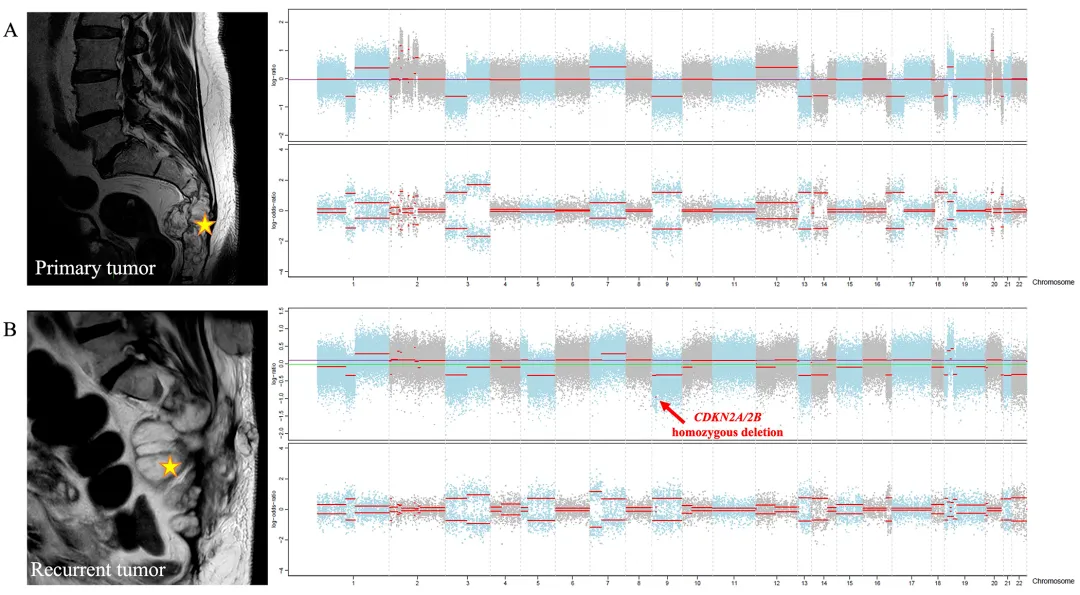 图示：骶骨原发性(A)与其局部复发(B)脊索瘤CNV特征之间的比较。