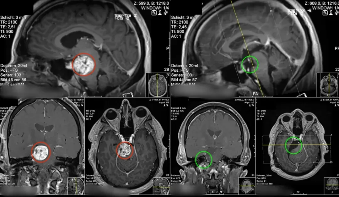 （术前术后MR对比）