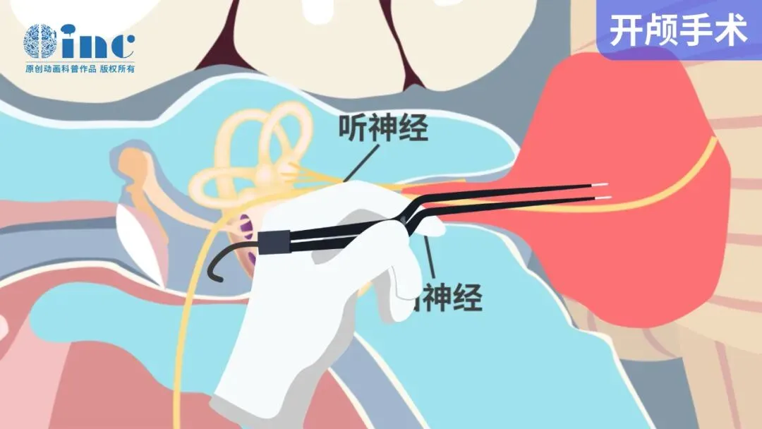 6年4次突发耳聋，竟是听神经瘤！她如何逃过面瘫、失聪的噩梦？