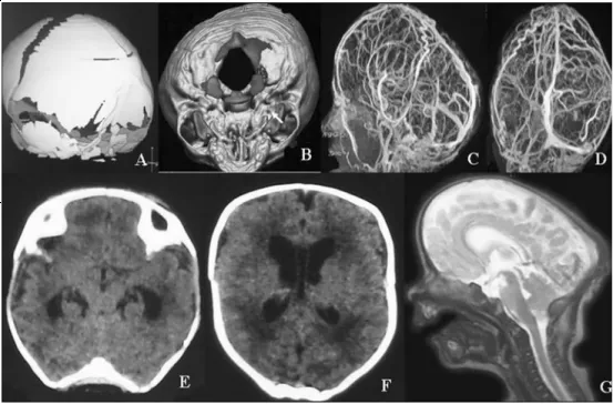 【INC国际大咖研究成果】复杂性颅缝早闭：临床特征与处理策略综述