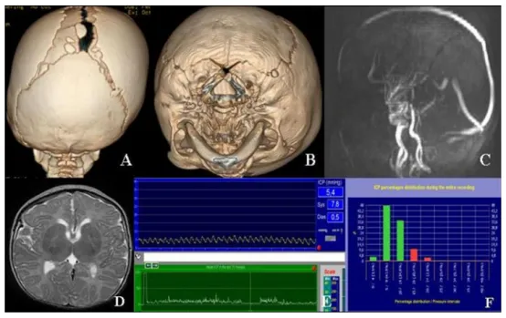 图2 Apert综合征:未发生活动性脑室扩大的有利因素