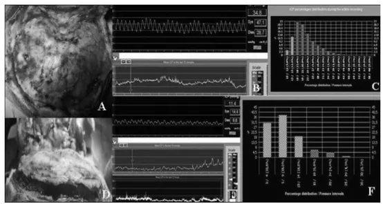 图3枕部游离扩大术