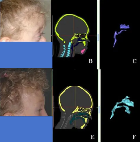 图4综合征性颅缝早闭的上气道受限:4岁Crouzon患儿