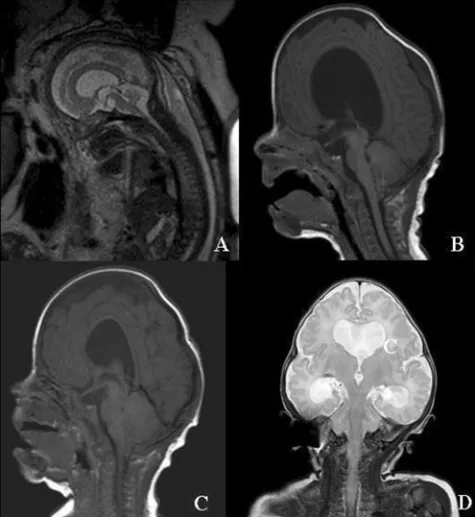 图5综合征性颅缝早闭中Chiari I畸形作为获得性、进行性病变——Crouzon综合征示例