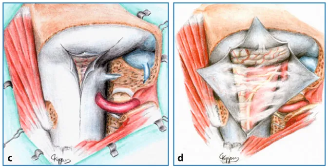 巴教授枕骨大孔区脑膜瘤研究分享：肿瘤暴露的基本原理图示