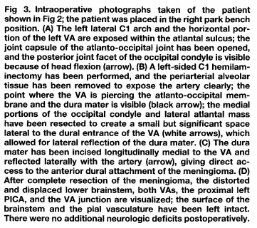 巴教授论文中对该则案例手术操作分享
