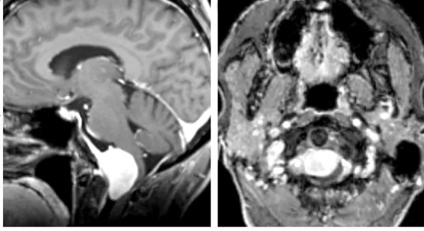不同医生不同治疗方案，75岁查出巨大枕骨大孔区脑膜瘤怎么办？
