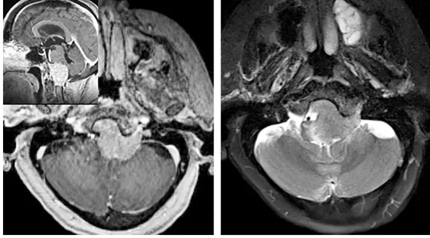 图：枕骨大孔脑膜瘤并脑干水肿提示软脑膜被侵及，提示采用次全切除来保护神经功能。