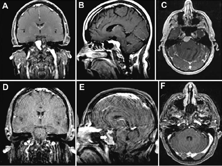 图示：术前图像显示起源于上斜坡的岩斜脑膜瘤