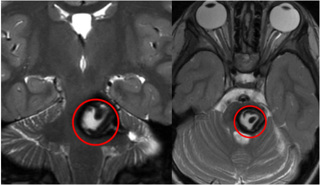 女儿多次脑干出血，我们都没发现瘤子，直到医生说不能手术……