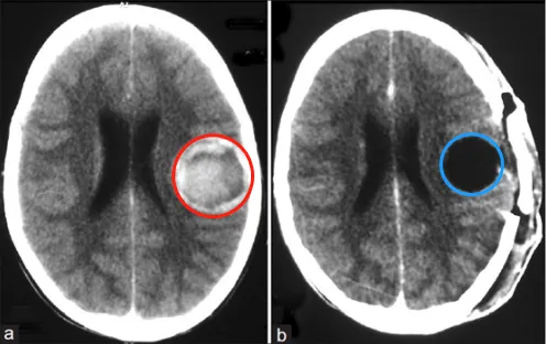 13岁男孩的4.5厘米“脑内风暴”：一场与巨大海绵状血管瘤的较量​！