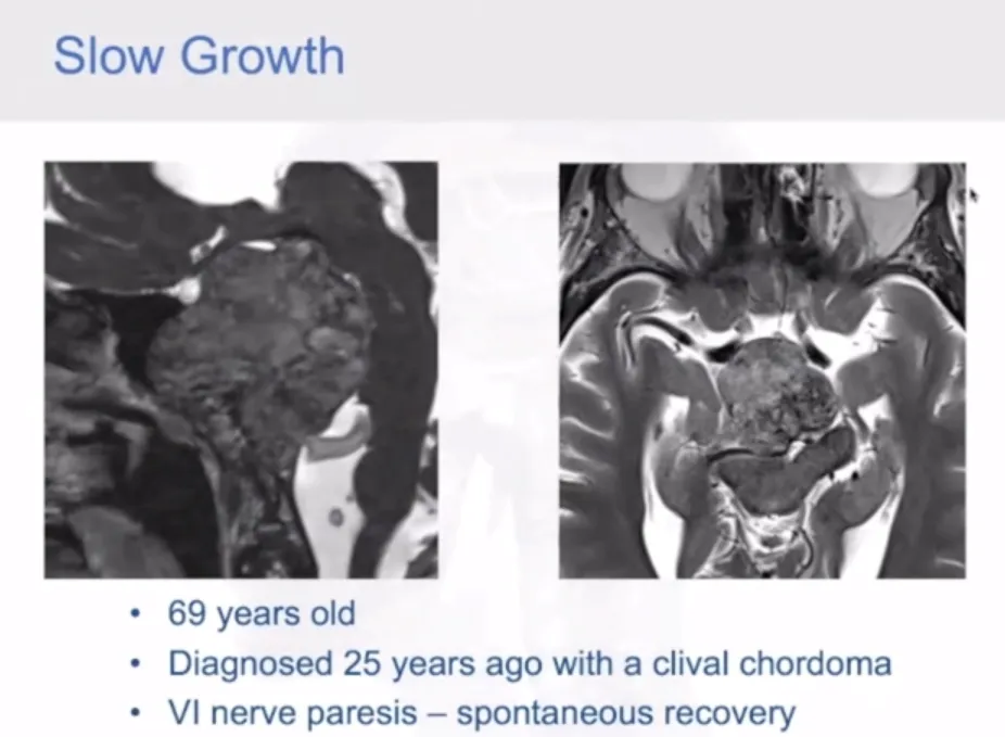 再凶险易复发的脑瘤，也怕一个“熬”到底的人，我如何平安度过了20年？
