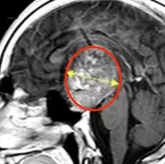 化疗无效、失明10年…少年决定向68mm³复发胶质瘤宣战！