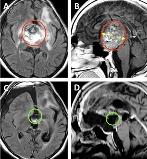 丘脑巨瘤如何自救