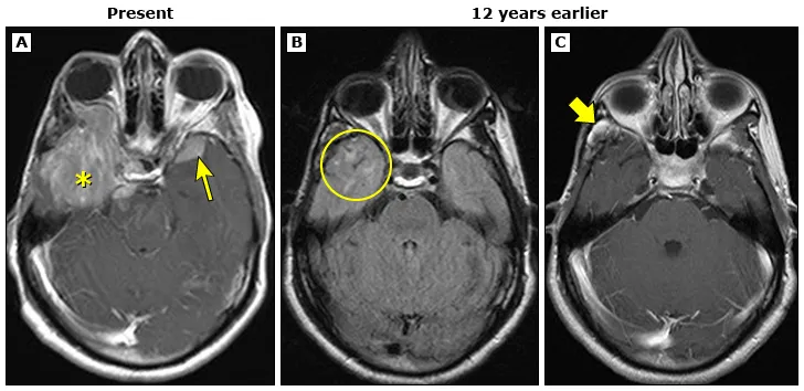 为什么会长脑膜瘤？与辐射/遗传/激素有关吗？