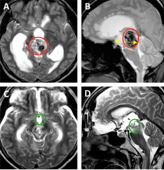 “我想好好上学，不想再提心吊胆了！”面对脑干手术禁区，这群20岁少年给出了答案