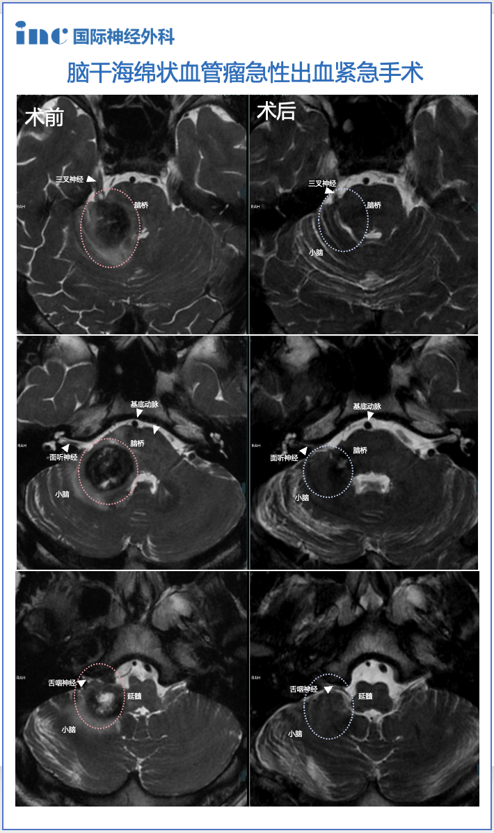 18岁桥臂海绵状血管瘤