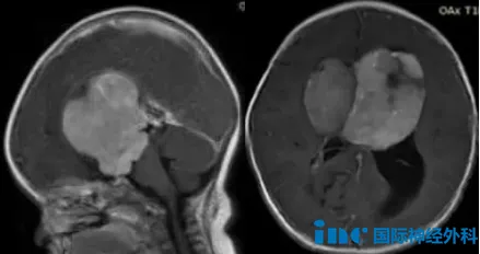 术后失明？不！她为胶质瘤宝宝“犟”出一条生路：有望治愈！