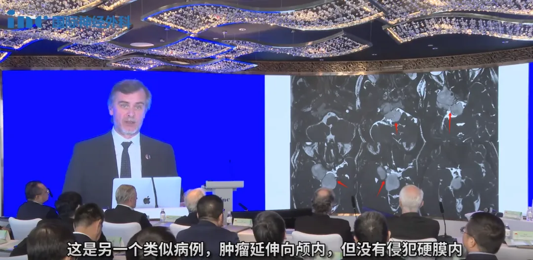 当脑瘤躲在“死角”里？没关系，这个神经内镜会“拐弯”