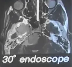 不开颅如何切除软骨肉瘤?