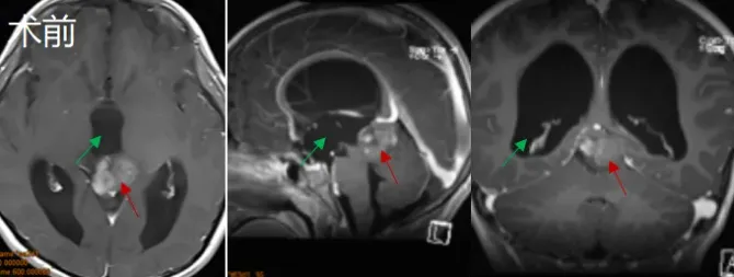 当母亲看到开颅术后的儿子：切完脑瘤后居然跟没事儿人一样！