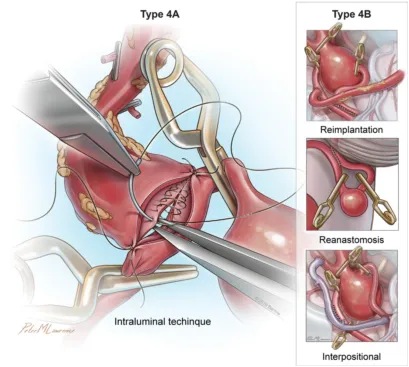 解除脑动脉瘤危机：开颅与介入，到底该选哪条路？