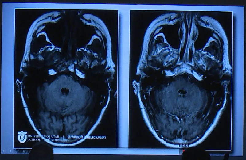 进行开颅手术，术后影像片子显示肿瘤切除干净。