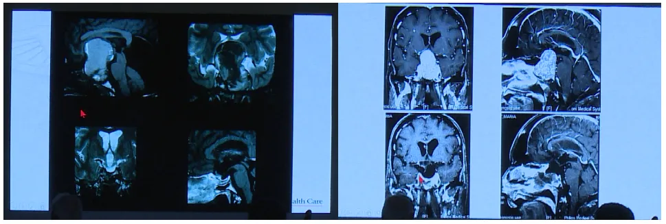 Couldwell教授演讲中展示的部分巨大垂体瘤