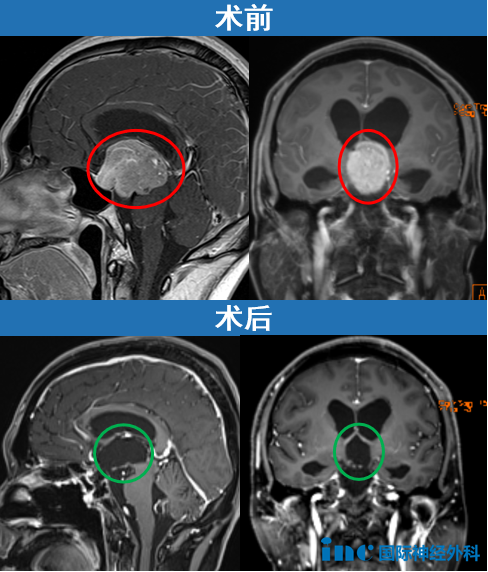 巨大垂体瘤一定要开颅吗？