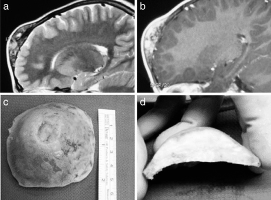 4年遭遇4次复发，Ki67飙升30%！这个脑瘤究竟有多可怕？