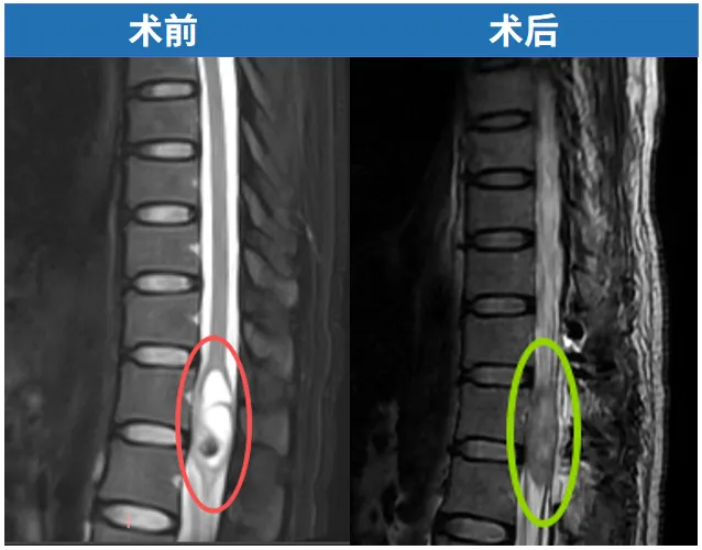 “脊髓髓内肿瘤观察只会加重病情？”决心手术的她，1个月阔步迎接新生活