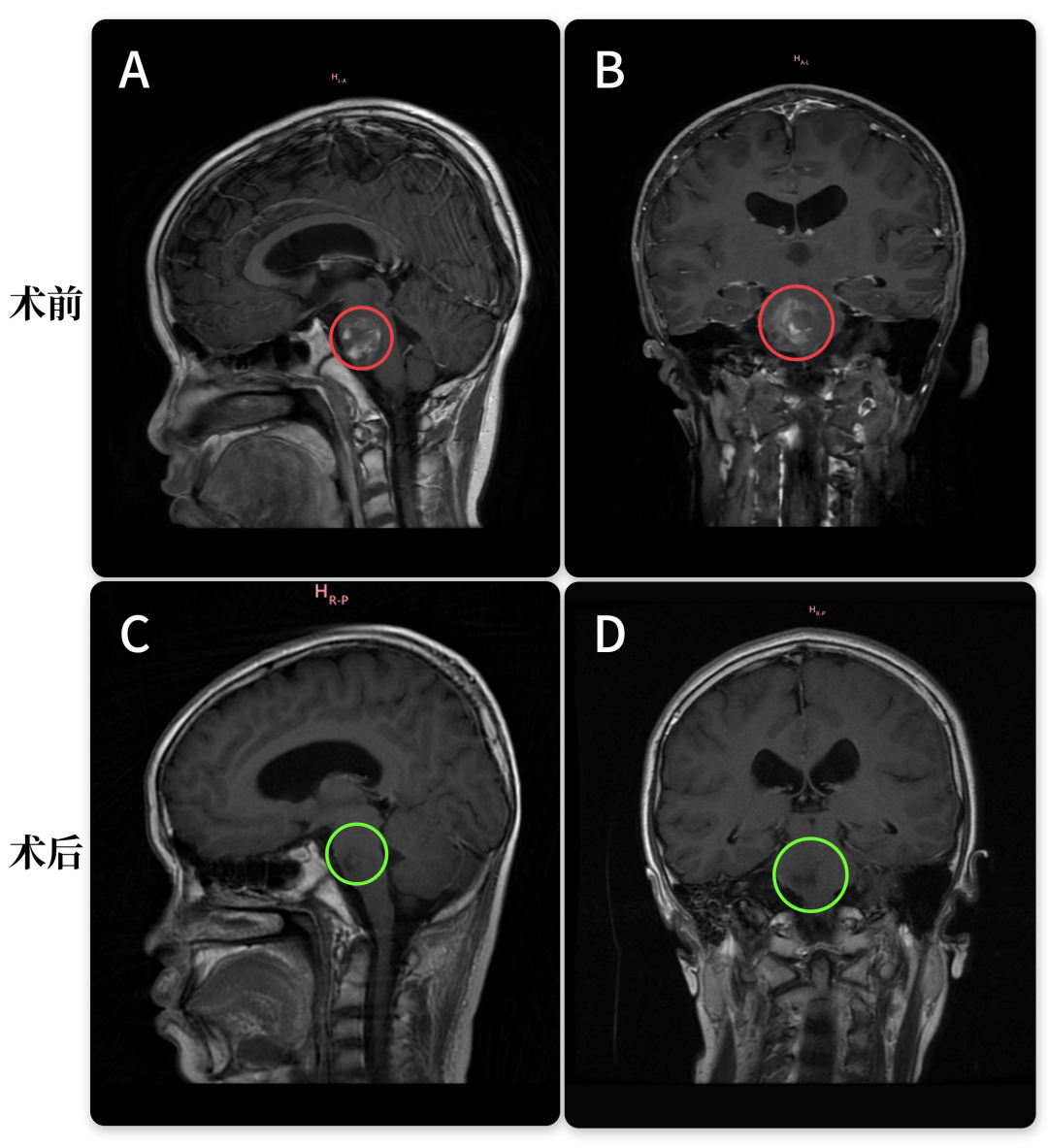 巴教授于2022年手术案例