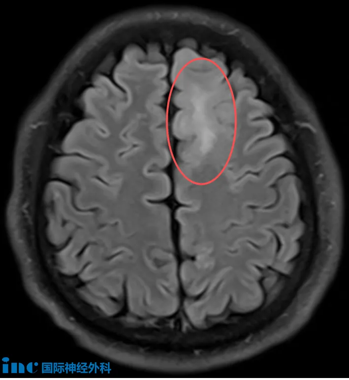 体检惊现脑部病变