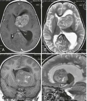 女儿因恶性脑瘤昏迷后，医生宣布病危，而我却看到一丝希望