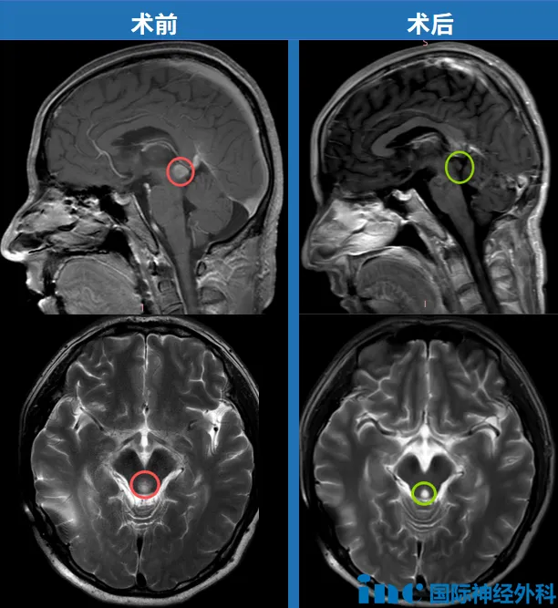脑瘤手术后多久恢复到正常人？脑干胶质瘤术后1天，他的世界重新按下“播放”键