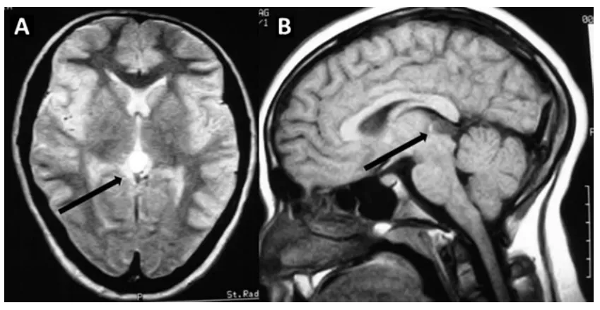 “妈妈，我头又痛了，眼睛好像也看不清了……”松果体囊肿会自己消失吗？