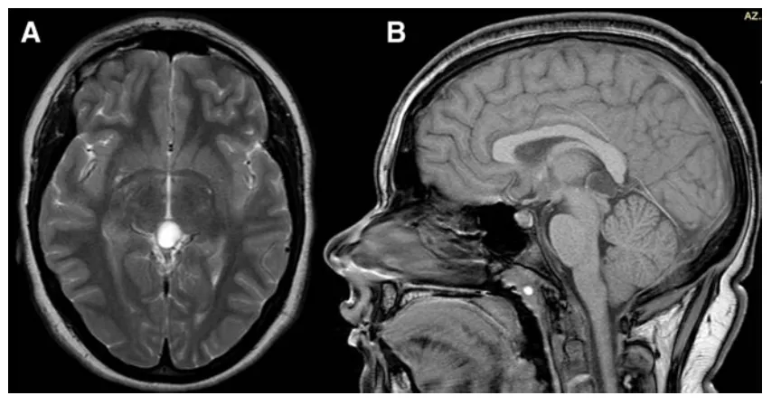 图2术前MRI，3年后复查，囊肿略增大（直径16 mm）。