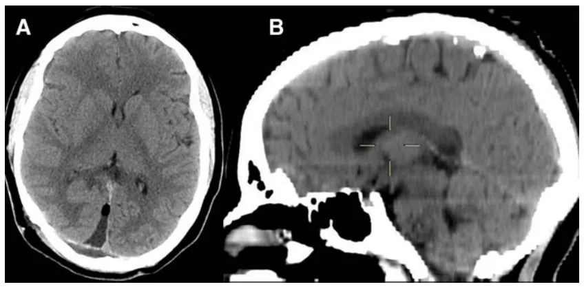 图3术后即刻CT证实囊肿已完整切除。由于右枕叶牵拉，手术入路通道仍清晰可见（a）。
