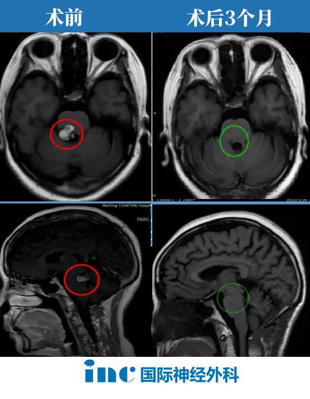 伽马刀治疗脑干海绵状血管瘤无效，病灶还变大了！