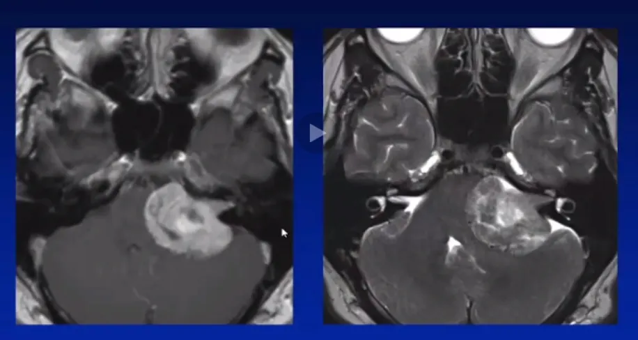 36岁男子持续耳鸣听力下降，一查竟是巨大听神经瘤！治疗难度竟这么大…