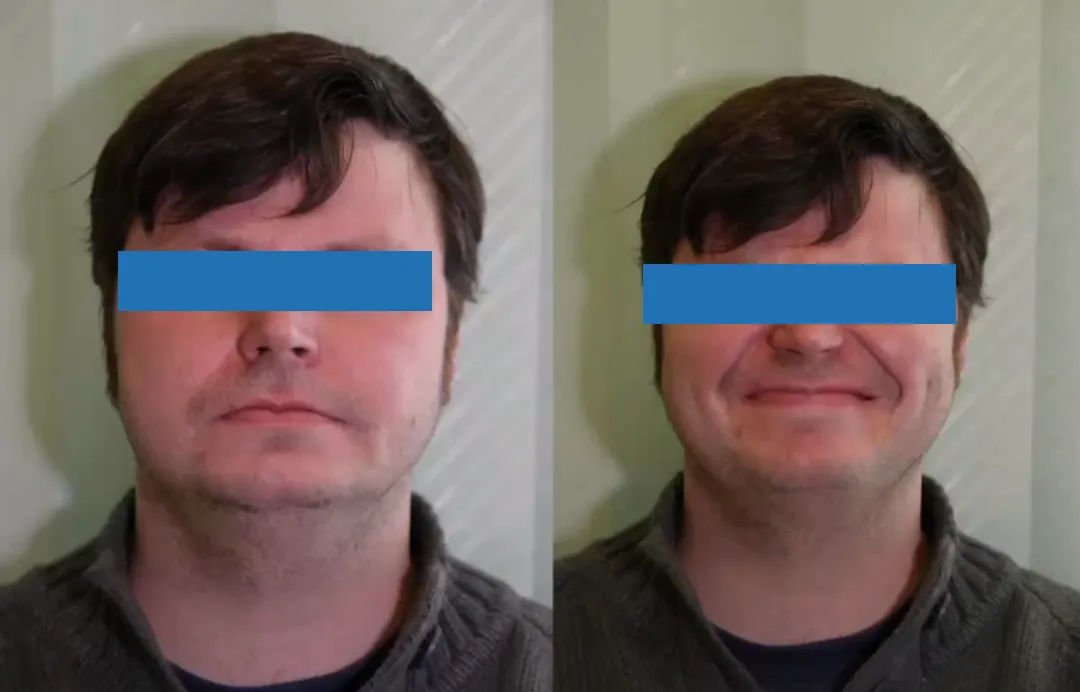 术中全切，术后无面瘫