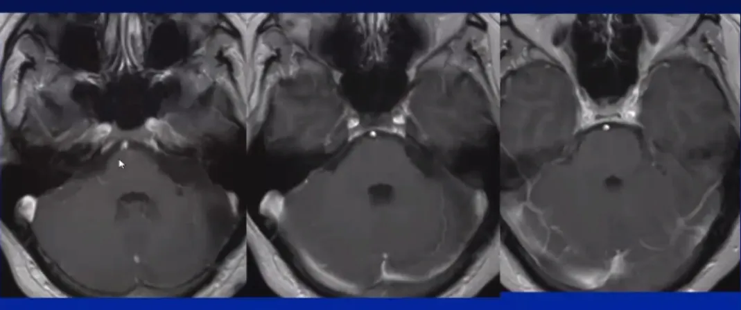 术后10年随访，一切正常