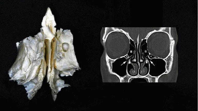 筛骨，它实质上是两块骨在中线由筛板连接而成。