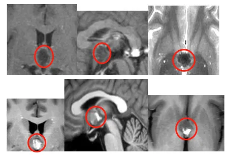 失明、记忆丧失… 三脑室海绵状血管瘤手术的凶险谁懂？