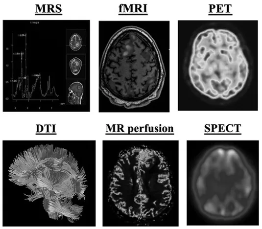 PET、MRS、DTI、fMRI…检查分不清？5大胶质瘤影像技术如何“各显神通”