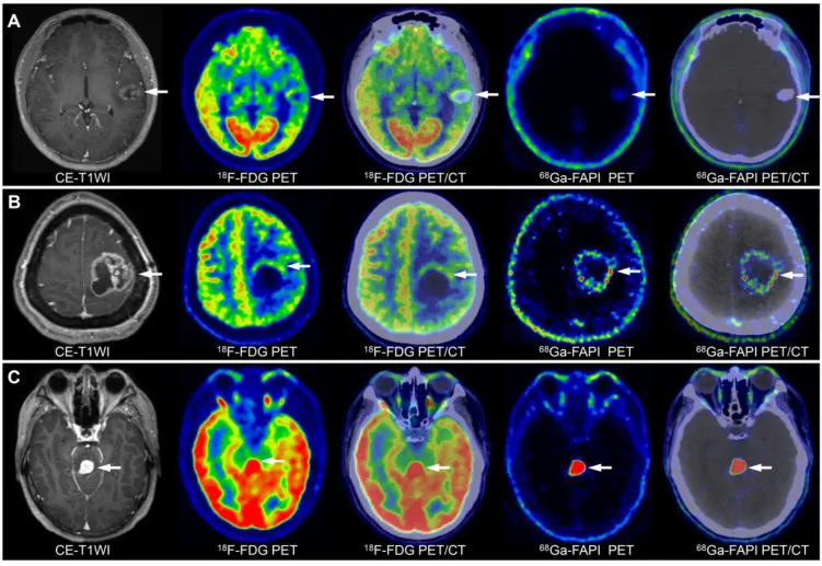 不同级别胶质瘤影像特征：A，低级别胶质瘤；B，三级胶质瘤；C，司机胶质瘤。