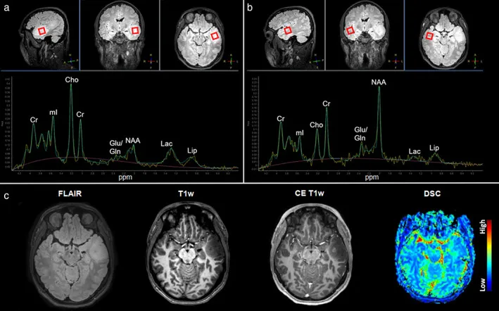 <a href='/bingzhong/jzmxbl/' target='_blank'><u>胶质母细胞瘤</u></a>MRS