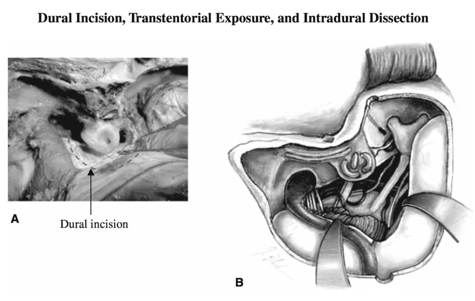 图2：左：迷路后迷路联合岩骨旁入路。标准硬膜切口和Fukushima岩骨旁入路的显露（A）。岩斜脑膜瘤切除术后的照片（B）