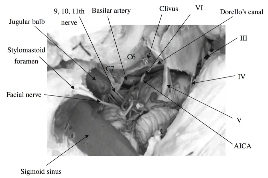 图3：此时，暴露ICA的小部分（C6-C7段），基底动脉和下颅神经。Dorello管由两根韧带组成：蝶岩韧带和外展神经通过的Gruber韧带。