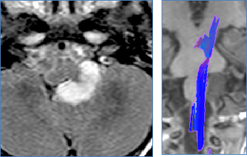 “孩子确诊脑干胶质瘤，必须一次手术搞定，我们不想再开颅了！”